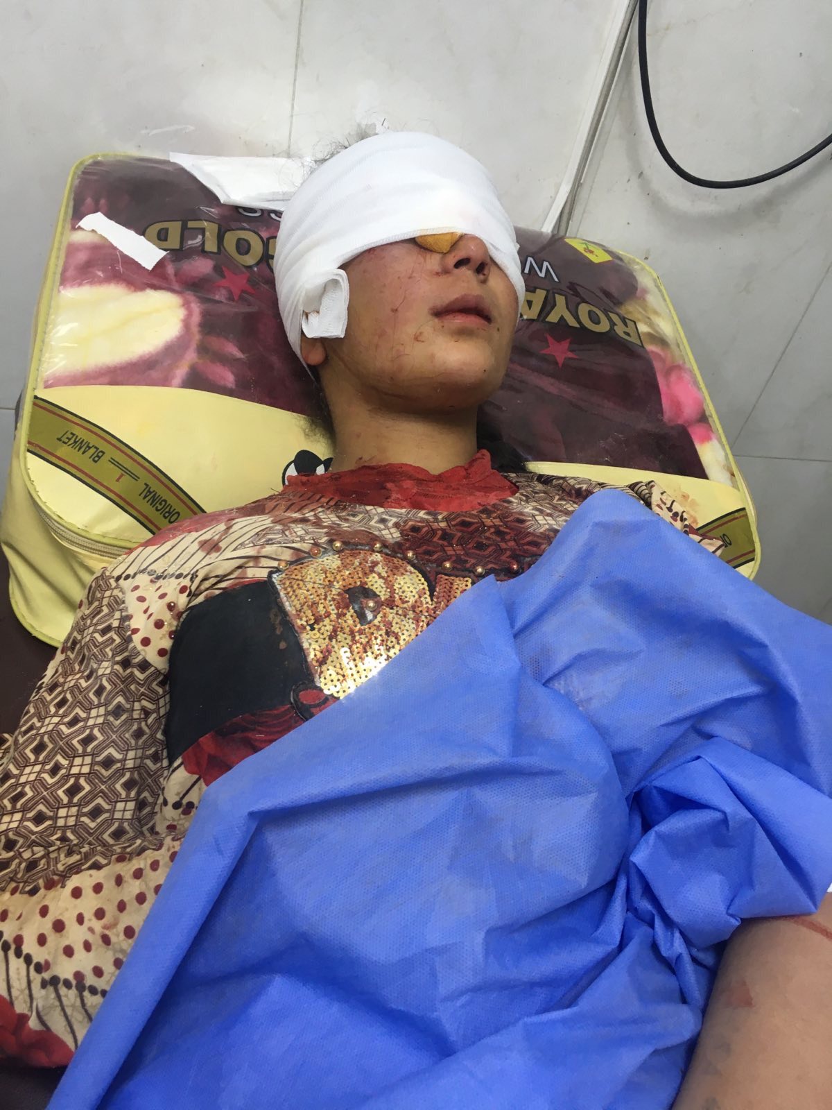 وێنەی کچە بریندارەکەی گوندی گوداد لە ناحیەی زیلکان وێنەی کچە بریندارەکەی گوندی گوداد لە ناحیەی زیلکان