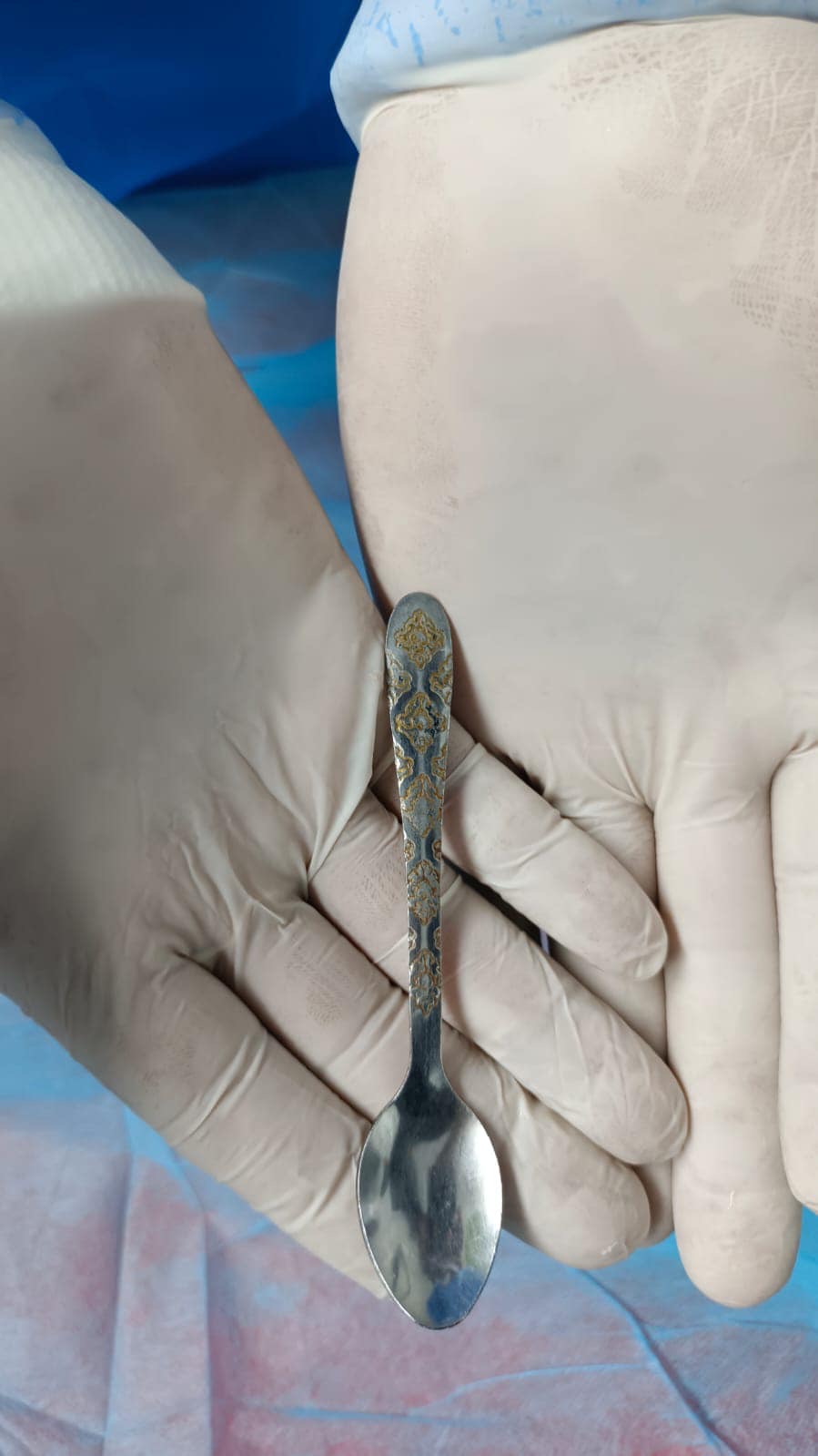 وێنەی ئەو کەوچکەی لە گەدەی ژنەکەدا دەرهێندراوە