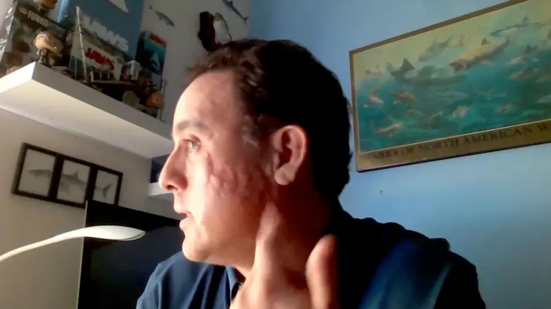 Şopên diranên semasiyê li ser rûyê Mauricio Hoyos\ Wêne: BBC Şopên diranên semasiyê li ser rûyê Mauricio Hoyos\ Wêne: BBC