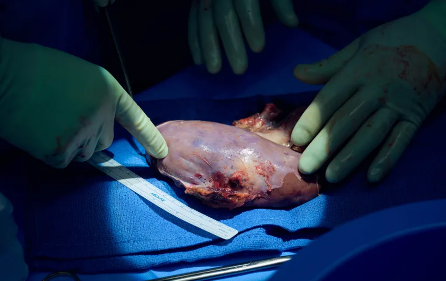 کاتی دەرهێنانی گورچیلەی بەراز لە جەستەی ئەو پیاوە مردووەی تاقیکردنەوەی لەسەر کرا.