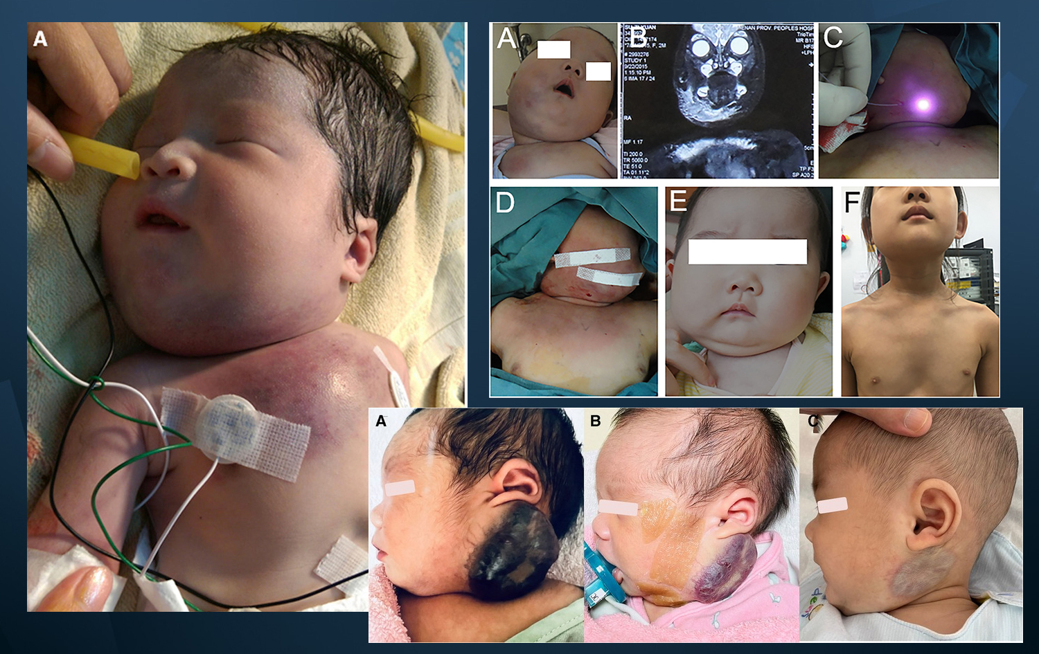 بەشێک لەو منداڵانەی کە تووشبووی KMS بوون، ناسراوە بە کۆنیشانەی کازاباخ مێریت