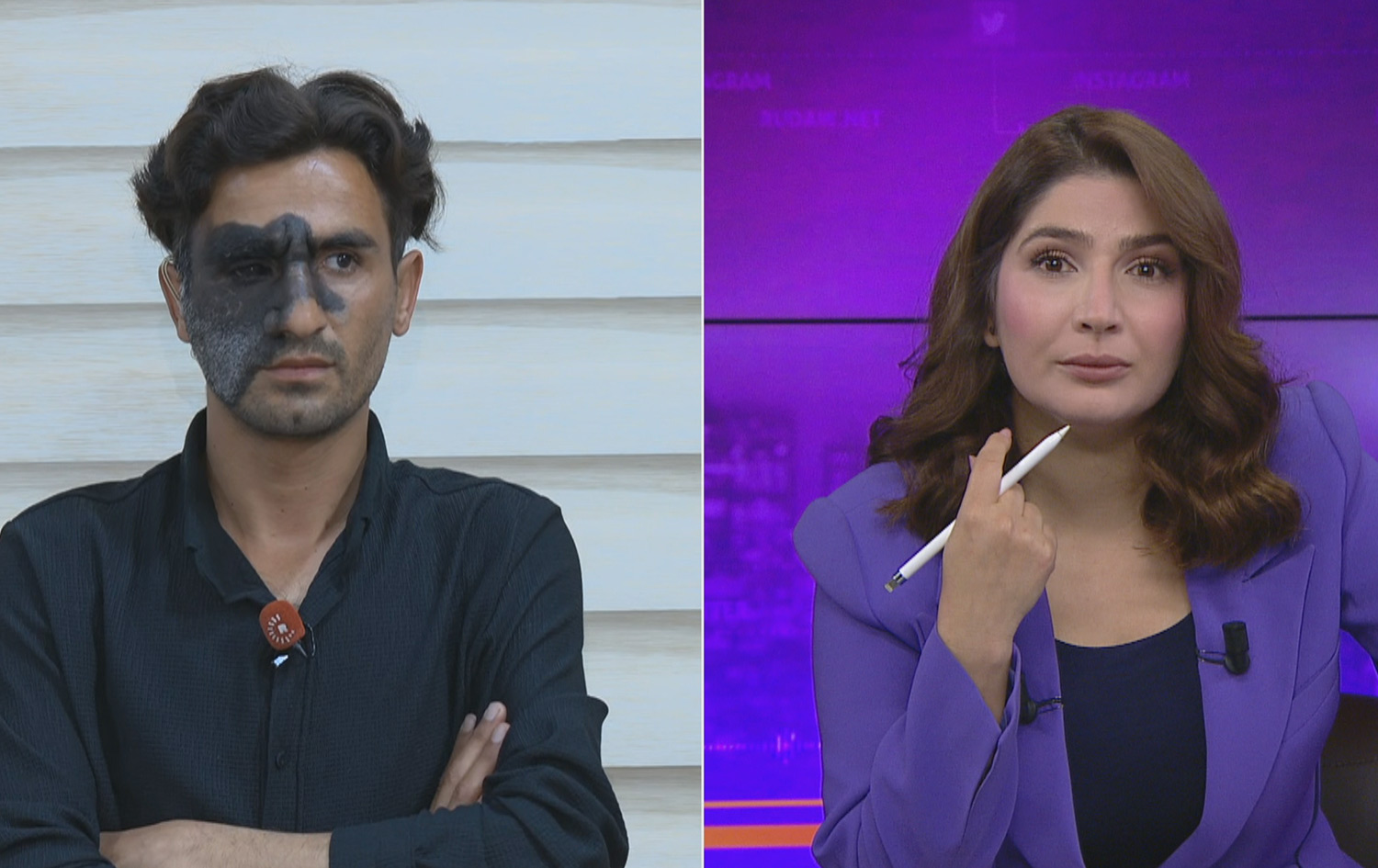 گەنجێکی 25 ساڵ: بەهۆی نیشانەی دەموچاومەوە ئاستەنگ بۆ پێکهێنانی ژیانی هاوژینیم دروستبووە