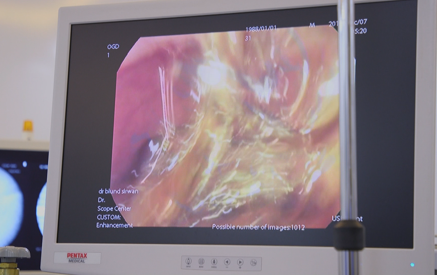 Norin 14122019 keshakani colon