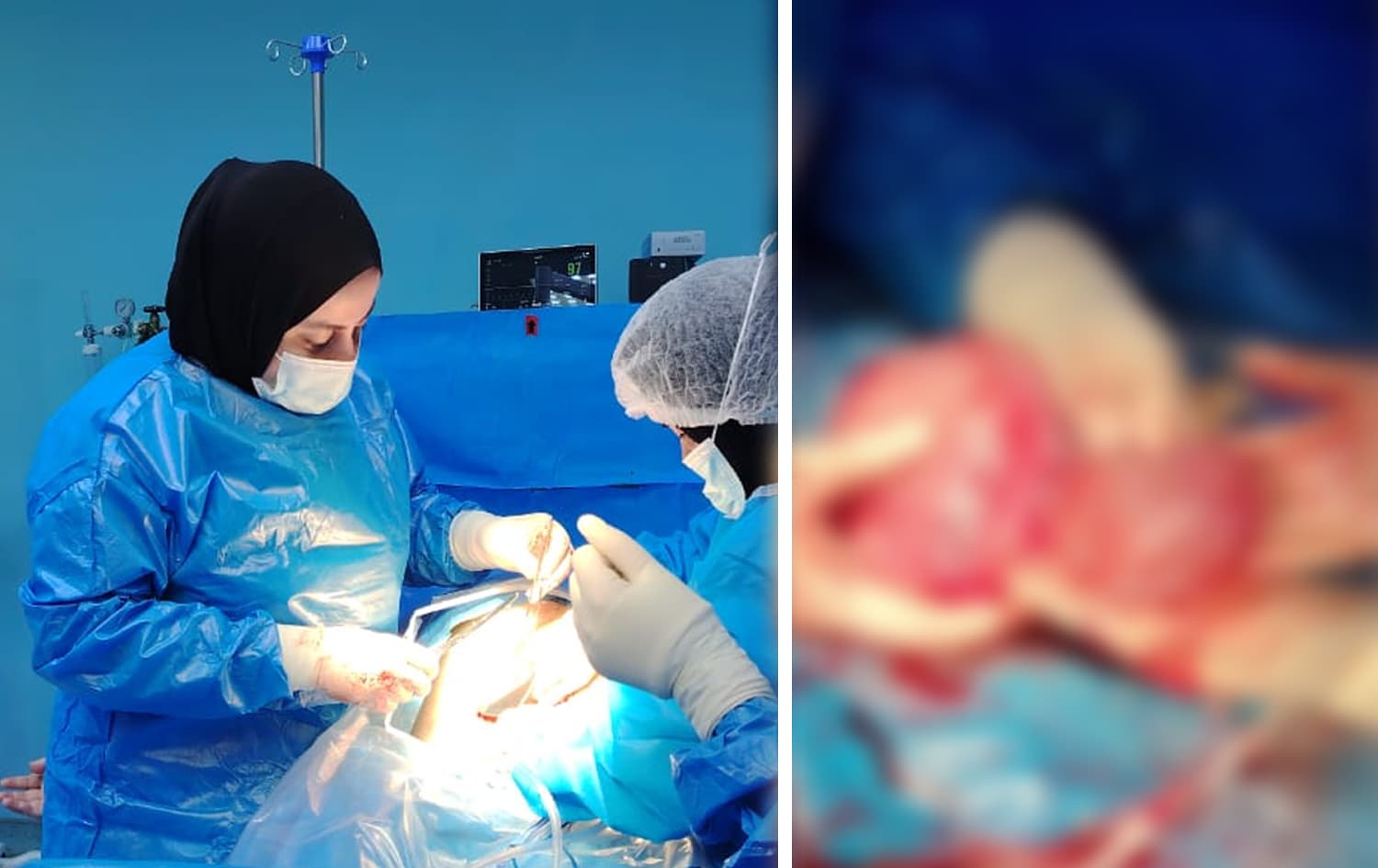 لە سۆران لەکاتی نەشتەرگەریی منداڵبووندا، کیسێکی گەورەی پێنەزانراو دەردەهێندرێت