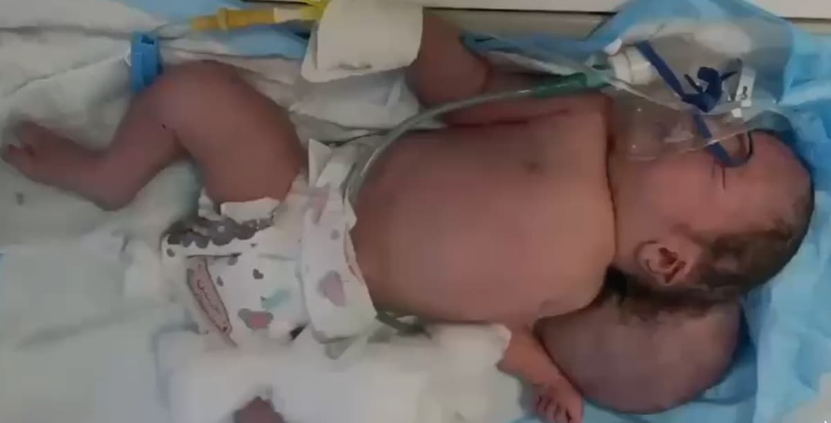 لە حاڵەتێکی دەگمەندا؛ لە تکریت منداڵێک بە تەنیا یەک چاوەوە لەدایکبوو