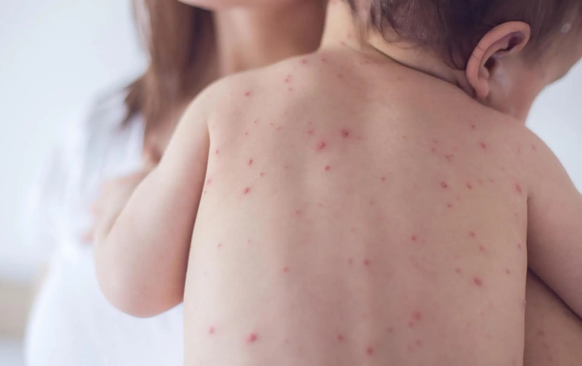 تەندروستیی هەولێر بۆ رووداو: 70 منداڵ تووشی سورێژە بوون و 200 منداڵیش کوتراون