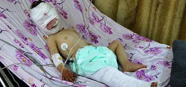 A severely wounded Syrian child is seen at a hospital in Afrin on March 5, 2018. Photo: AFP/Ahmad Shafie Bilal 
