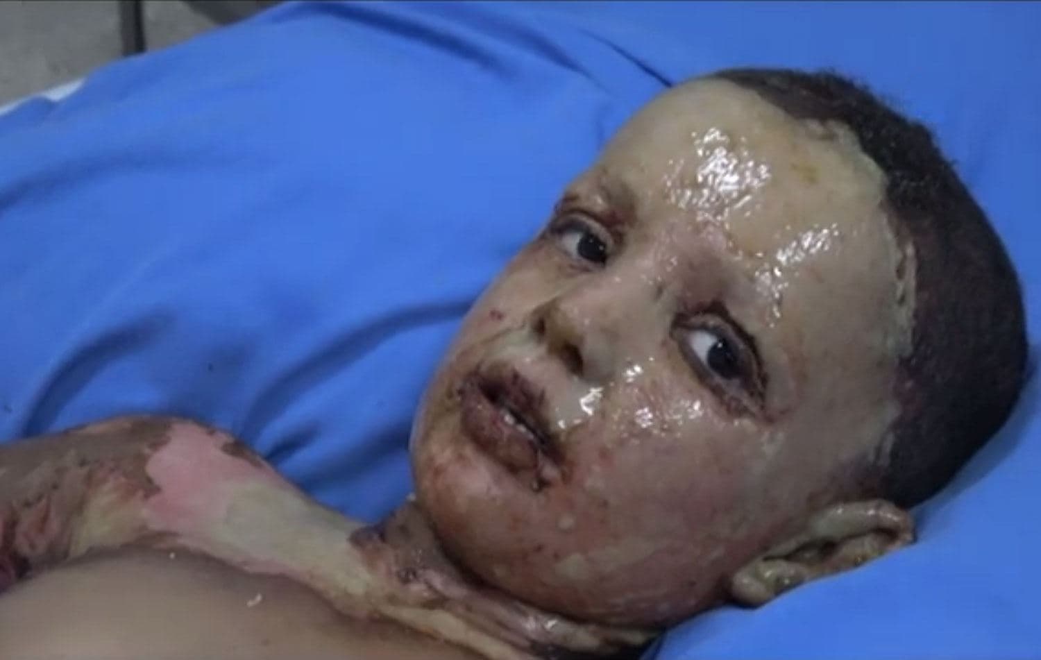 A child suffering from severe burns lies in a hospital in Hasakah on October 16, 2019. Photo: ANHA news video