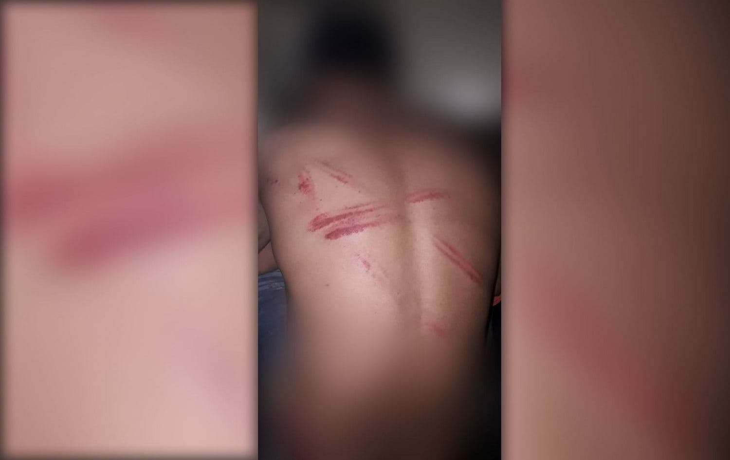 Photos taken on February 7 show protester Osamah* displays wounds allegedly sustained under torture by Sadrist militiamen in Baghdad on February 6, 2020. Photo: submitted