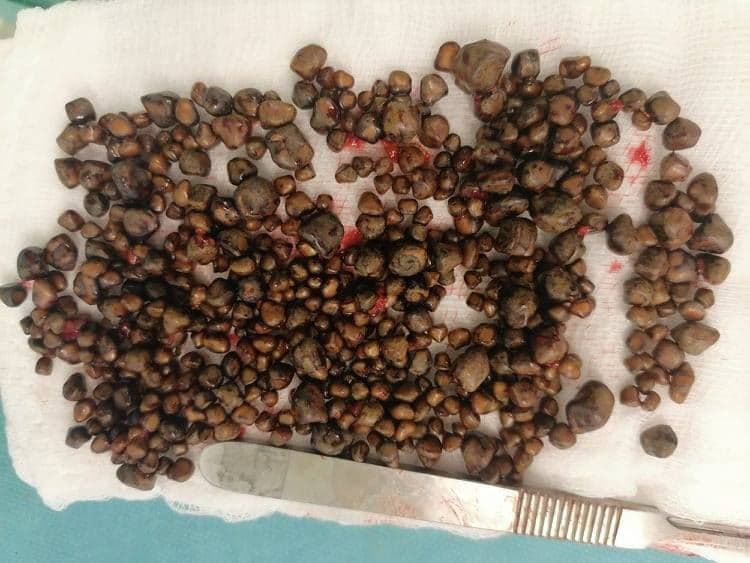 Erbil surgeon extracts 537 stones from woman’s gallbladder