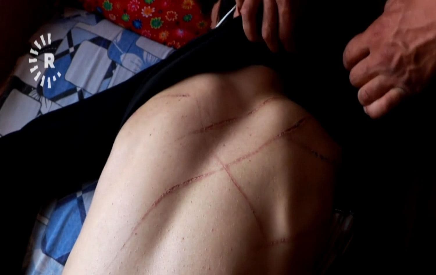Samadi shows his scars resulting from torture by Turkish soldiers. Photo: screenshot