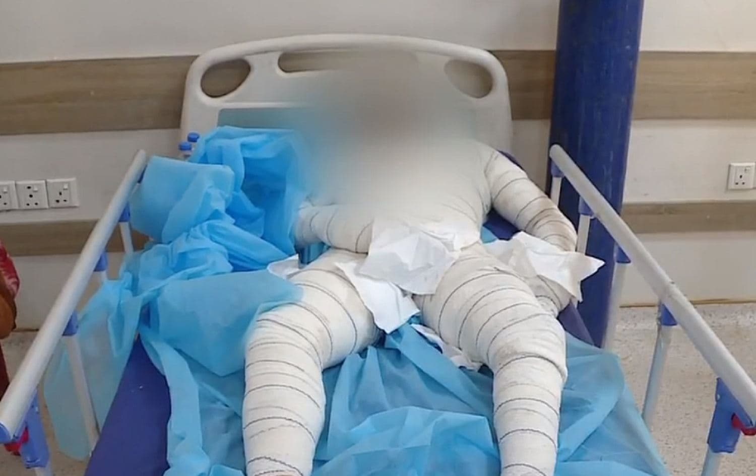Behzad Mahmoudi lies in a hospital bed after setting himself on fire in protest infront of the UNHCR office in Erbil on May 18, 2021. Photo: Rudaw