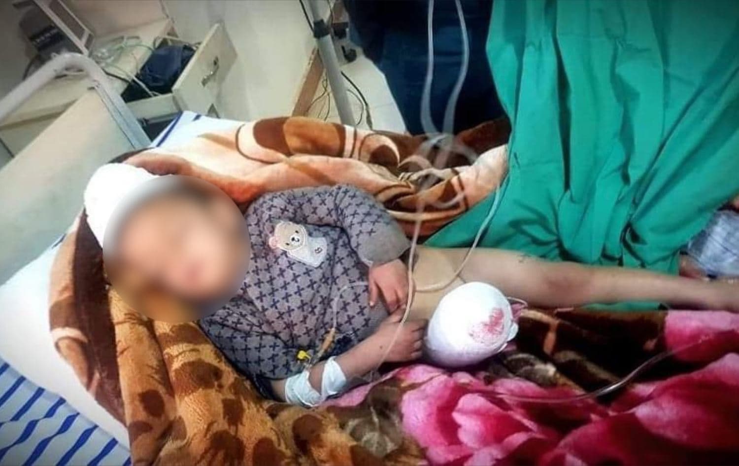Photo of four year old Abdou Mustafa Hanifi, who lost a leg in the suspected Turkish attack in Kobane on January 8, 2021. Photo: Farhad Shami on Twitter