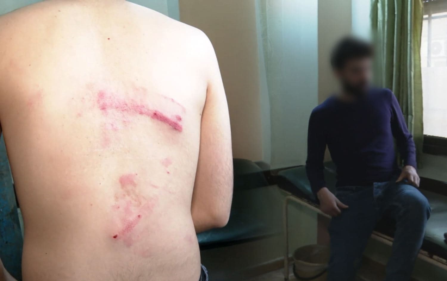 Rudaw cameraman Issa Hassan after being tortured by unidentified people in Qamishli on February 2, 2022. Photo: Rudaw