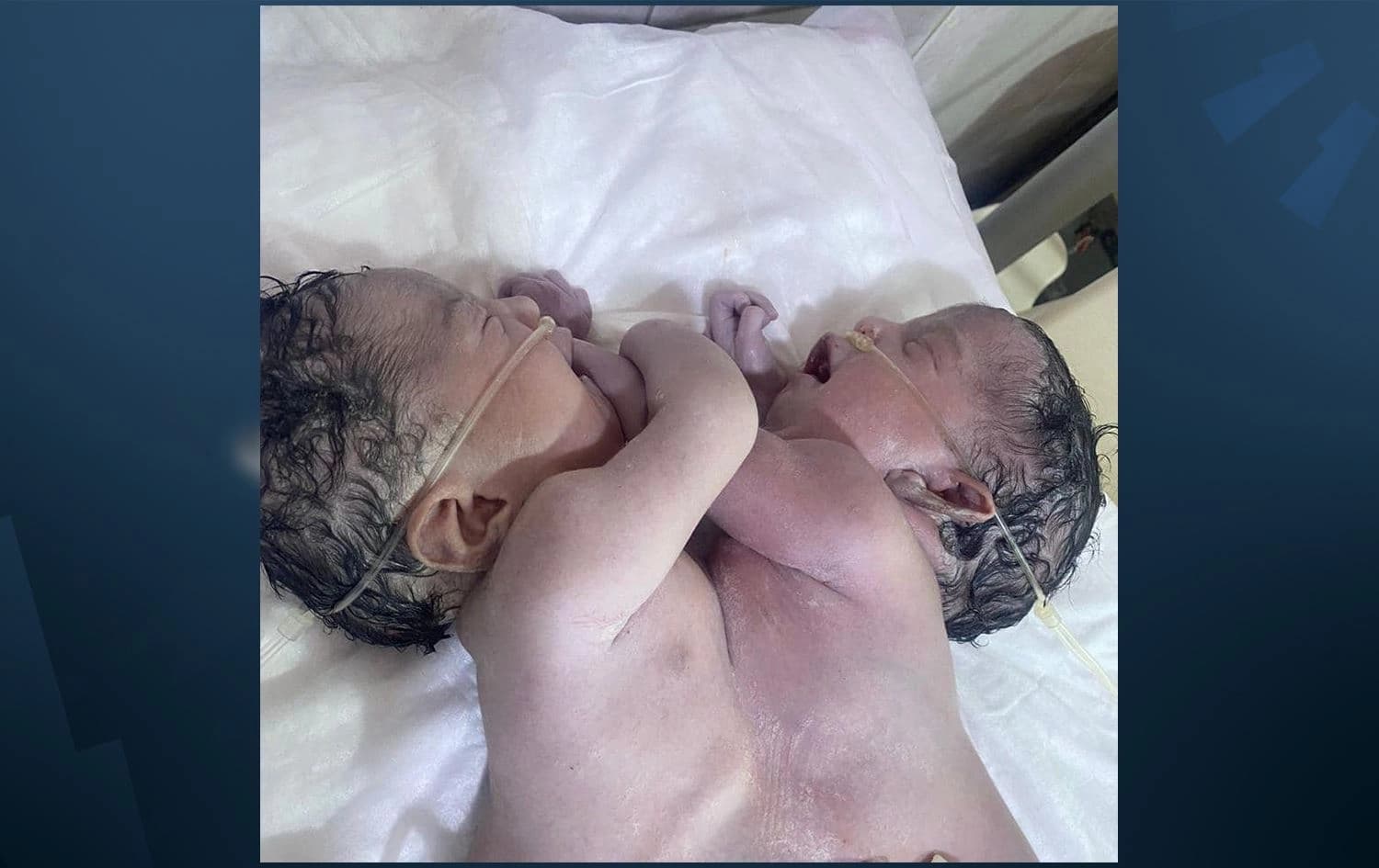 وێنەی ئەو دوو منداڵەی بە لکاوی لەدایکبوون. 