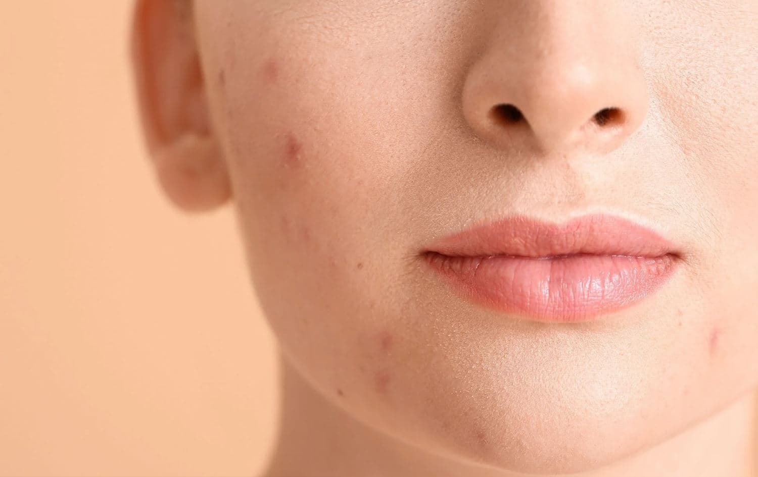 پەڵە و شوێنەواری زیپکە لەسەر روخسار. وێنە: Myoclinic