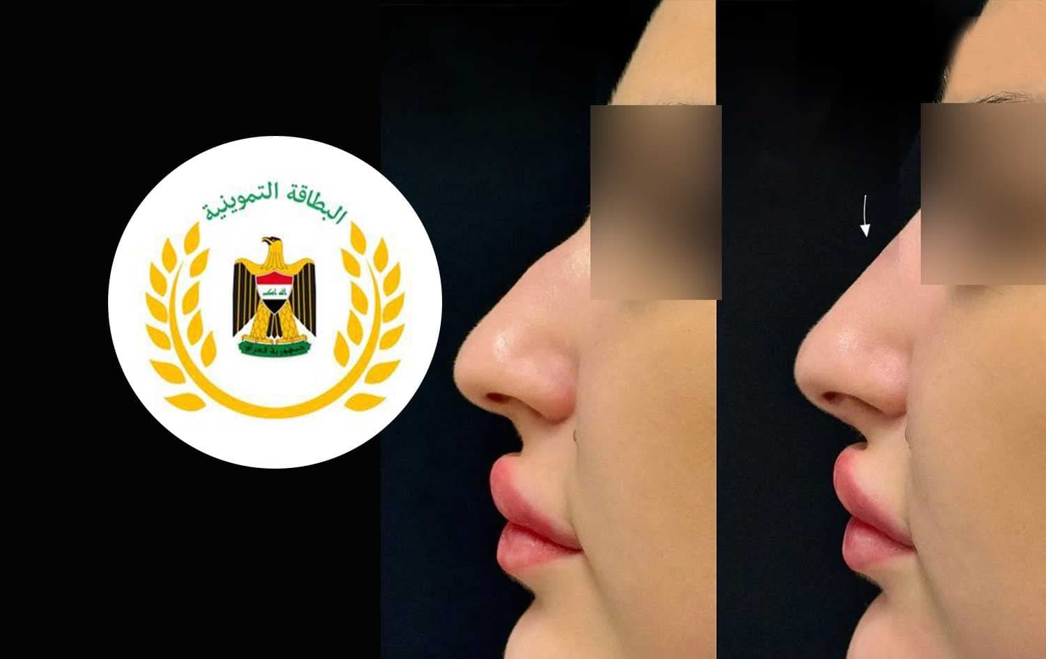 وێنەی خانمێک کە نەشتەرگەریی جوانکاری لووتی کردووە و لۆگۆی پسووڵەی خۆراک