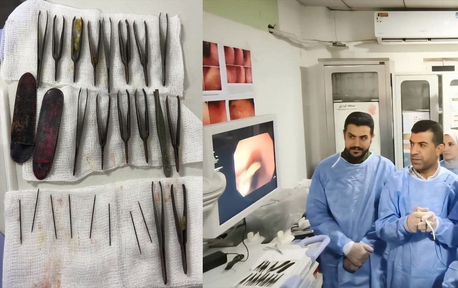 Sulaimani man swallows 24 tweezers, needles in rare medical case