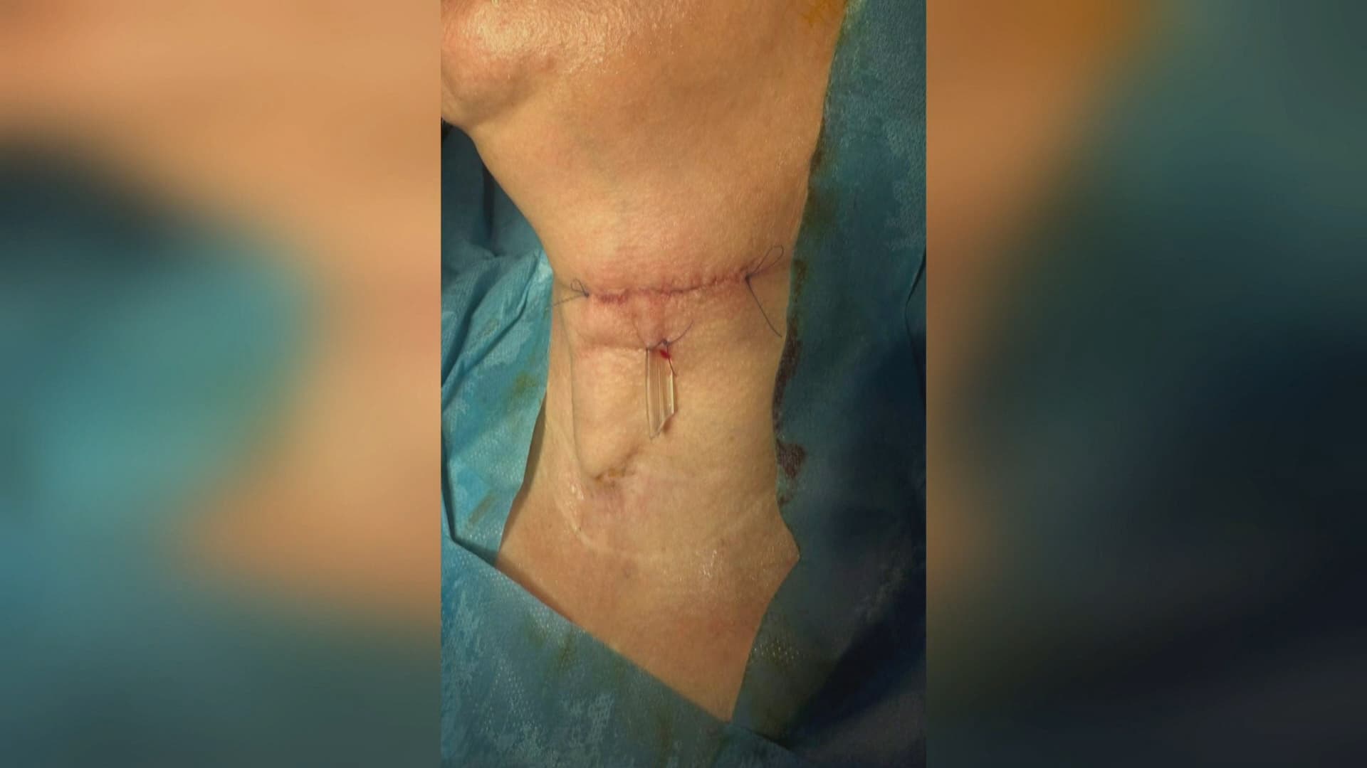 وێنەی پاش نەشتەرگەرییەکە.