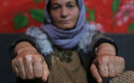 Baseh Hammo, a Yezidi woman who escaped ISIS, shows the injuries to her hands at a relative’s tent in a camp for displaced people outside Duhok, February 28, 2019. Photo: Khalid Mohammed / AP