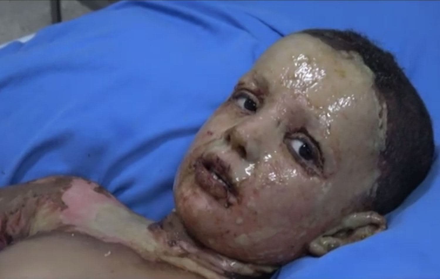 Zarokek li Nexweşxaneya Hesekê ku serûçav û destên wî şewitîne, 16ê Cotmeha 2019. Wêne: ANHA