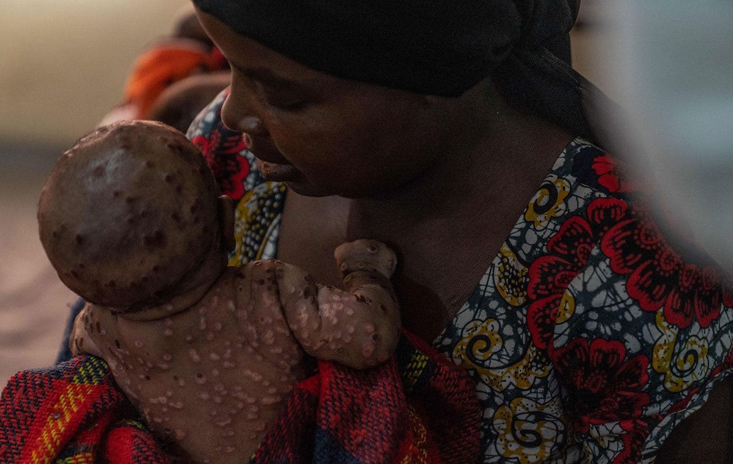 Kongo Demokratik Cumhuriyeti'nin doğusunda, Bukavu kentinin 30 km kuzeyindeki Kavumu hastanesinde maymun çiçeği hastalığına yakalanmış olan bir çocuk ve annesi. / AFP