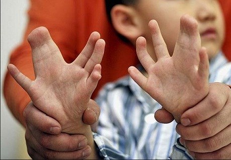 Savaş genleri bozdu / Erbil’de 2 siyam ikizi