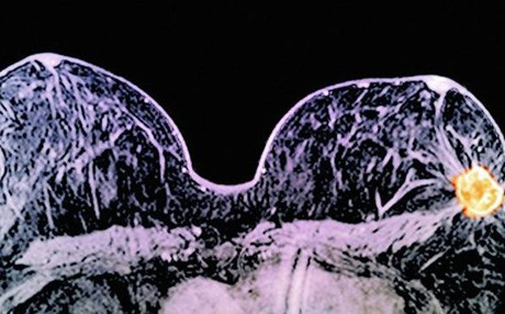 چارەسەرێکی نوێ بۆ شێرپەنجەی مەمک دەدۆزرێتەوە