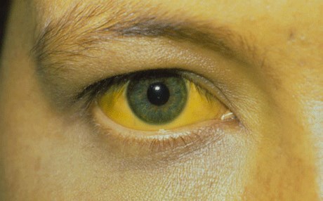 زه‌رده‌تا له‌ كۆنگۆی دیموكرات به‌ خێرایی ته‌شه‌نه‌ ده‌كات