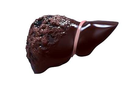 دانیشتووانی هەولێر 3%یان تووشی نەخۆشیی هەوكردنی جگەری ڤایرۆسی بوون