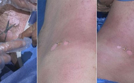 TELAFER - Peşmergeye kimyasal saldırı