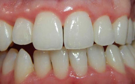 چل و یەك جین پەیوەندییان بە هەوكردنی پووكەوە هەیە