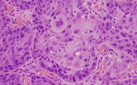 یازدە نیشانەی شێرپەنجەی چووك