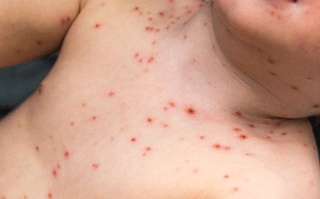 لەبارەی دڕکە و مێکوتە  لە منداڵدا