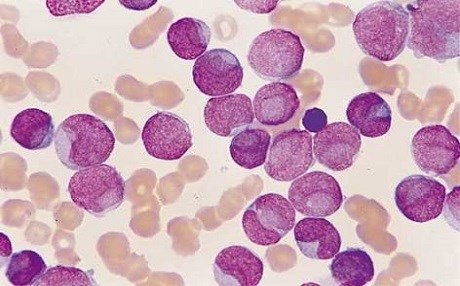 Fazla hijyenik yaşam çocuklarda lösemi riskini artırıyor