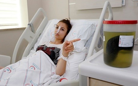 Midesinden 1,5 kilogram saç çıkarıldı!