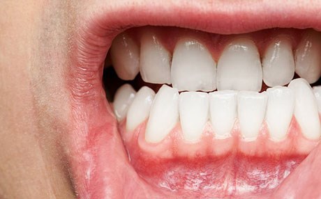 پەیوەندی نێوان هەوکردنی پووک و رەپنەبوونی چووک دەبینرێتەوە