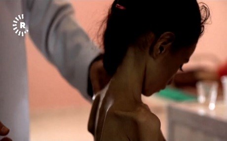 Li Yemenê hejmara zarokên ji ber nêzan nexweş bûne zêde dibe