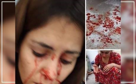 Tûşî nexweşiyeke giran bûye: Xwîn ji çavên wê tê