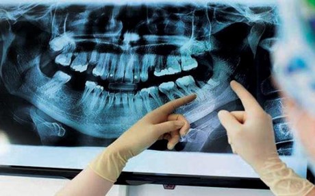 باحثون: مرضى التهاب اللثة المزمن معرضون للإصابة بالخرف أكثر بـ6% عن غيرهم