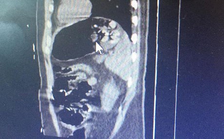 Midesine 192 gram eroin sakladı