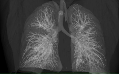 تەندروستی جیهانی ستراتیژییەتێكی نوێ بۆ رووبەڕووبوونەوەی سیل رادەگەیێنێت