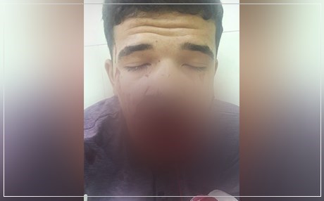 Cixareya elektronîk di devê wî de teqiya