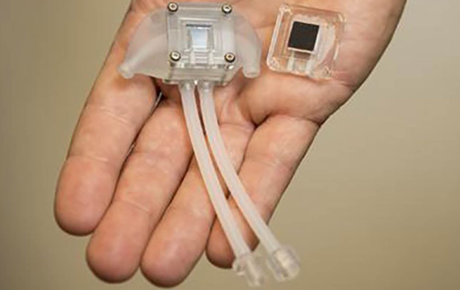 گورچیلەیەکی زیرەک هیوایەکی نوێیە بۆ تووشبووانی سستبوونی گورچیلە