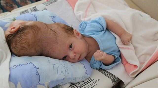 دوو منداڵی دووانە بە نەشتەرگەری سەریان لێک جوداکرایەوە