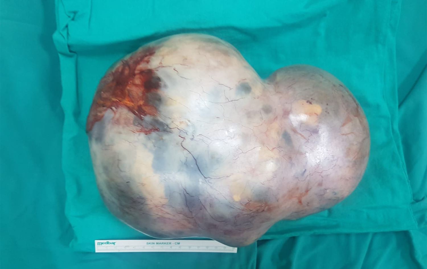 Diyarbakırlı 17 yaşındaki kızın karnından 5 kiloluk tümör çıktı