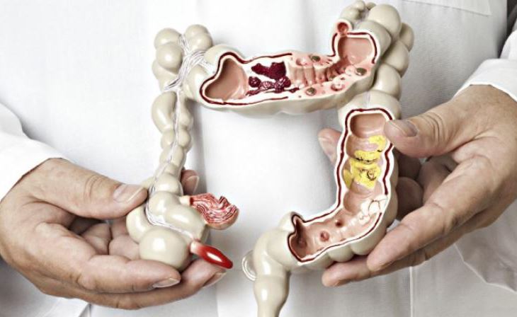 پزیشکانی بەریتانی پەیوەندی نێوان قەڵەوی و تووشبوون بە شێرپەنجەی کۆڵۆن ئاشکرا دەکەن