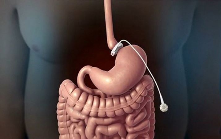 توێژینەوەیەک: نەشتەرگەری دابەزاندنی کێش مەترسیی جەڵتە کەمدەکاتەوە