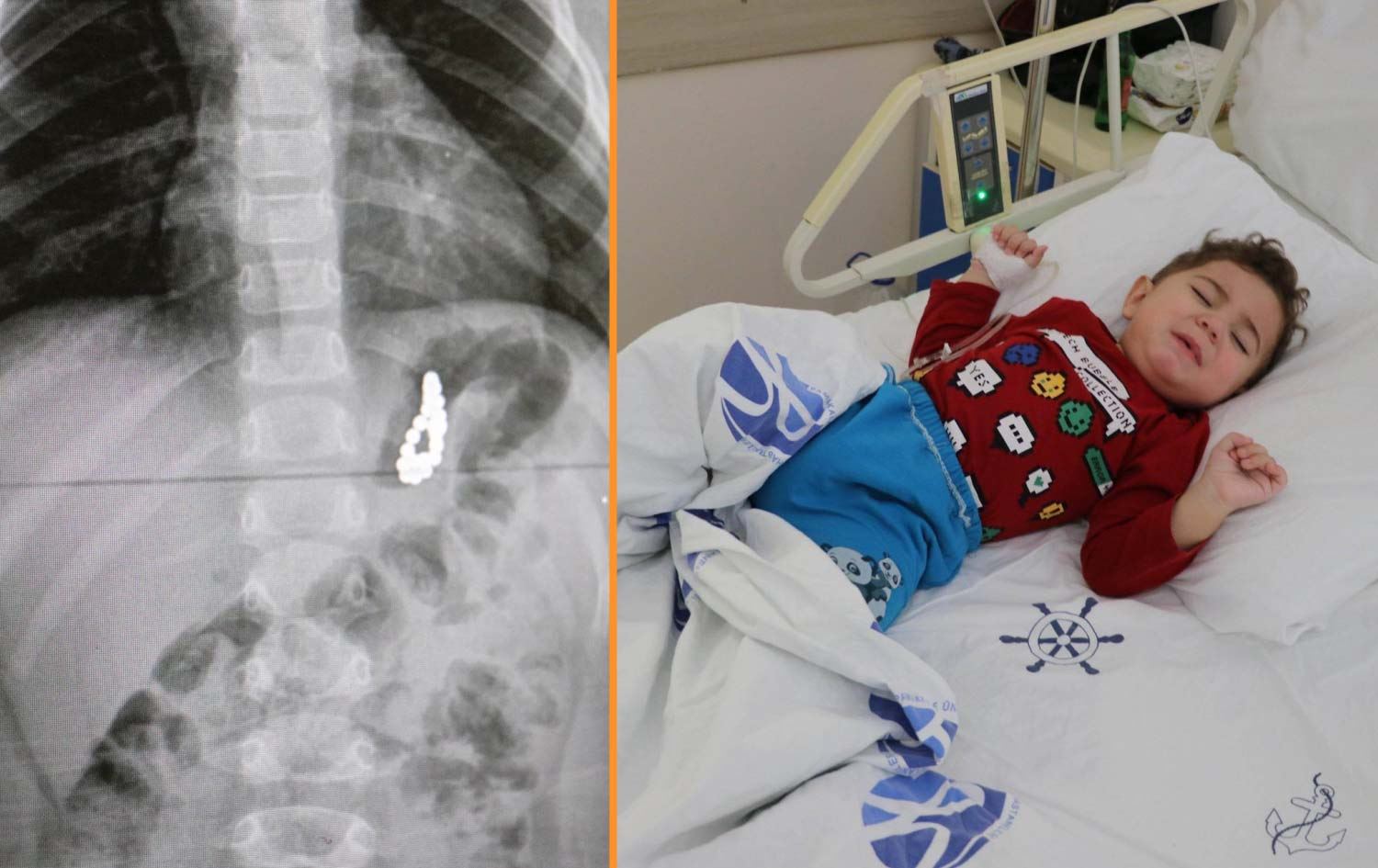 19 aylık bebeğin midesinden 17 adet mıknatıs çıkarıldı!