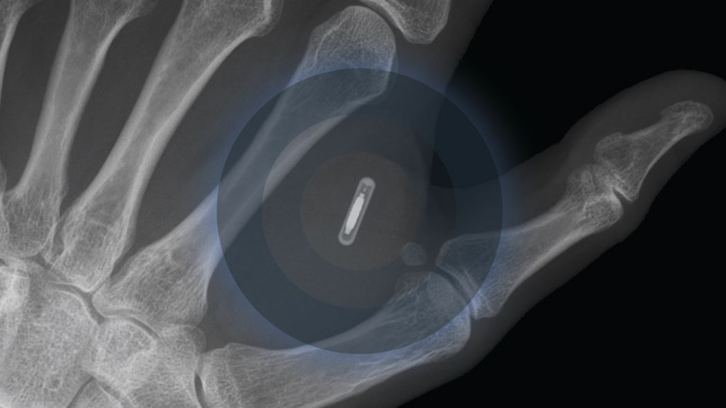 لە سوێد لەبری پاسپۆرتی ڤاکسین مایکرۆچیپ لەژێر پێست دادەنرێت